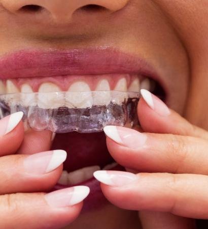 Close-up of female patient wearing braces in dental clinic